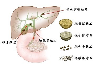 龙湖医院肝胆外科擅长治疗肝胆肿瘤,肝内外胆管结石,复杂性胆道疾病