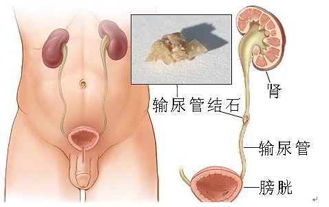 什么是输尿管纤维镜纤维输尿管镜碎石术-上海聚慕医疗器械有限公司
